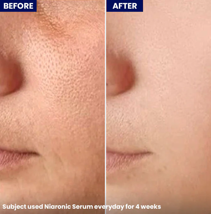 NiaRonic Serum (Pore Minimizing) - Image 5