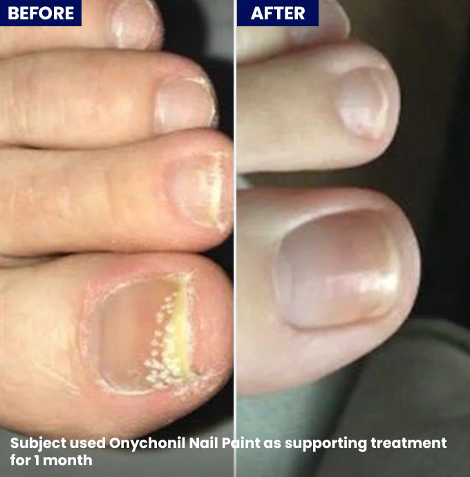 Onychonil Nail Paint - Image 4